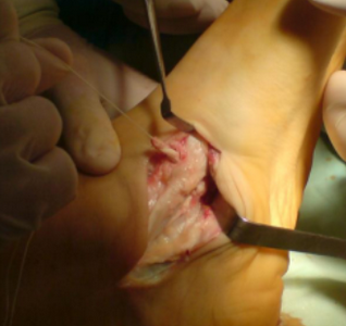 хирургическое лечение плосковальгусной деформации стопы