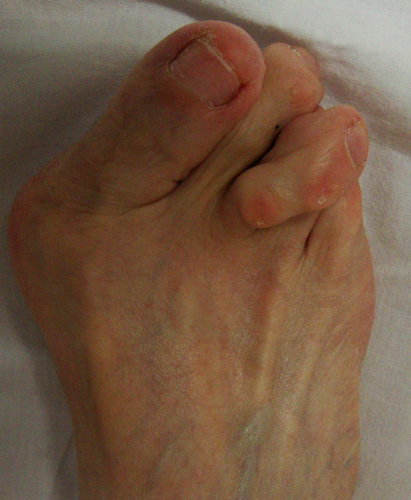 Малоинвазивное лечение контактных болезненных гиперкератозов пальцев стопы