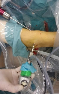 4b artroskopiya golenostopa operaciya