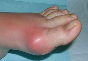 артрит-пальцев-ног