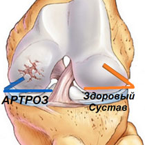 artroz-kolennogo-sustava