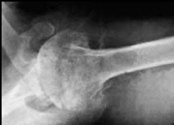 артроз-плеча-3-степени-рентгенограмма-2