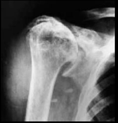 артроз-плеча-3-степени-рентгенограмма