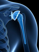 эндопротезирование-плечевого-сустава