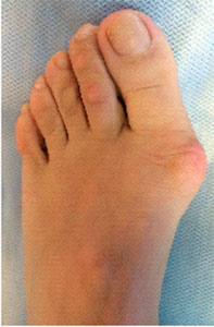 Лечение бурсита суставов ног лазером — аппараты ОРИОН.