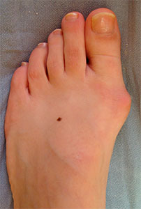 Диагностика бурсита большого пальца ноги