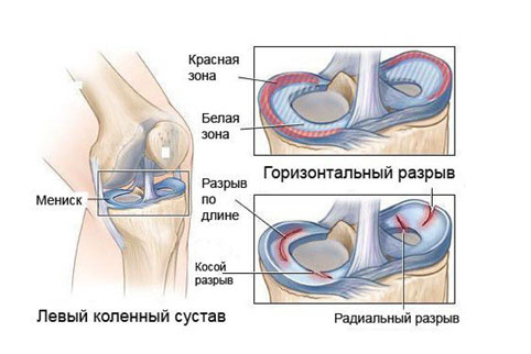 Виды разрывов мениска коленного сустава