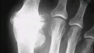 rentgenogramma-bolshogo-palca-s-artrozom