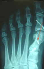 рентгенограмма-перелома-1