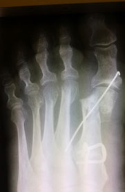 рентгенограмма-перелома-2