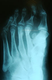 рентгенограмма-перелома-3