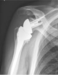 рентгенограмма-плеча-после-операции