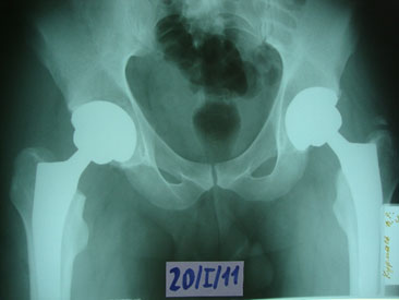 рентгенограмма-после-эптбс