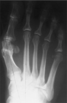 рентгенограмма-стопы-до2