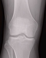 rentgenogramma-zdorovogo-kolena