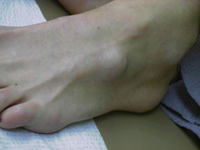 Косточки (шишки) на ногах - степени, причины, симптомы, лечение