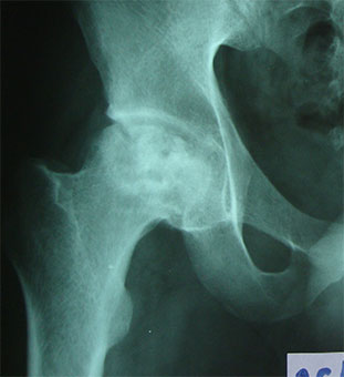 тазобедоенный-сустав-рентгенограмма