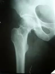 Лечение вколоченного перелома шейки бедра | Травматолог-ортопед ...